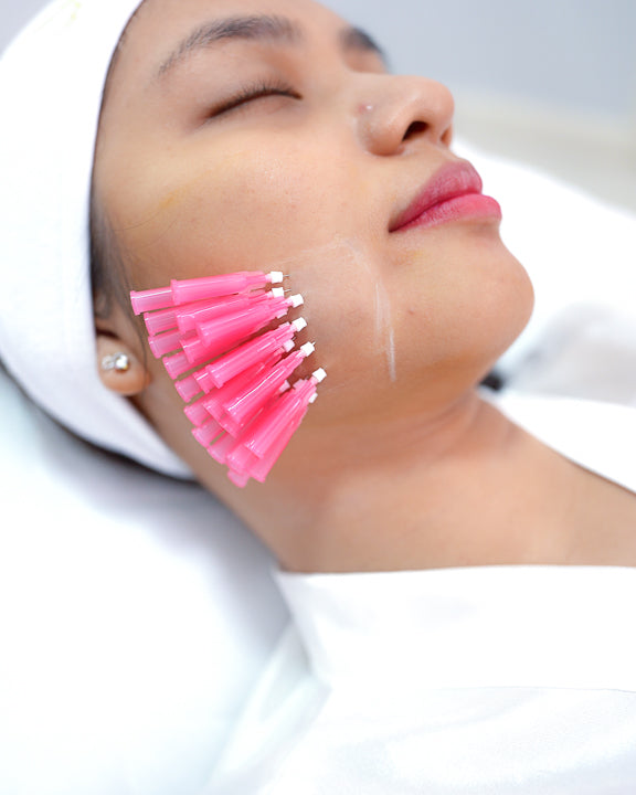 Korean V-Lift (PDO Threads)