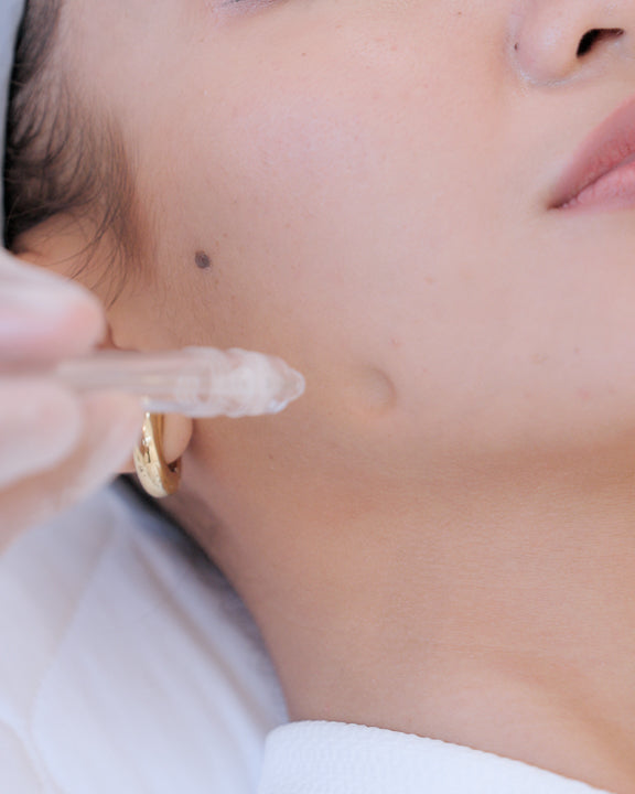 Jet Peel Facial