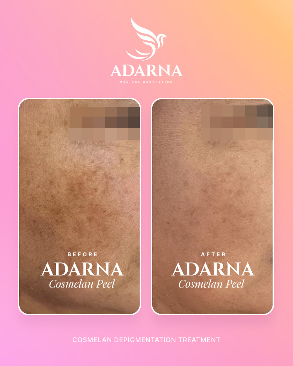 Mesoestetic Cosmelan Peel