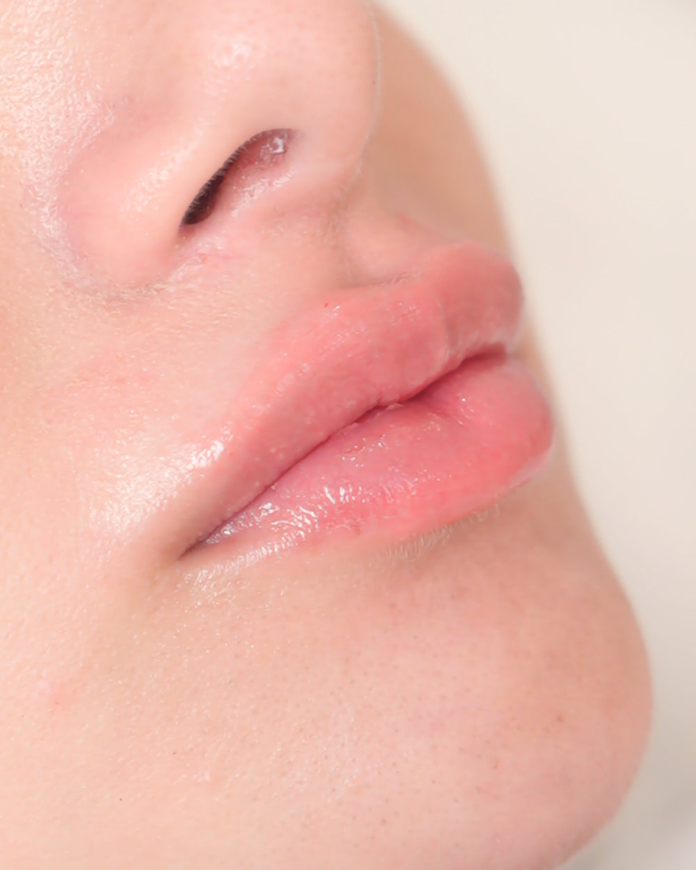 Lip Fillers