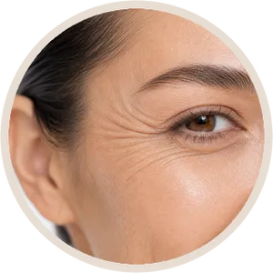 Crow’s Feet (per unit)