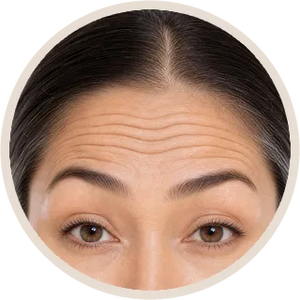 Forehead Lines (per unit)