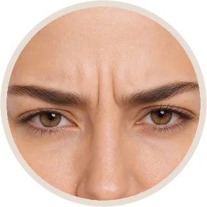 Frown Lines (per unit)