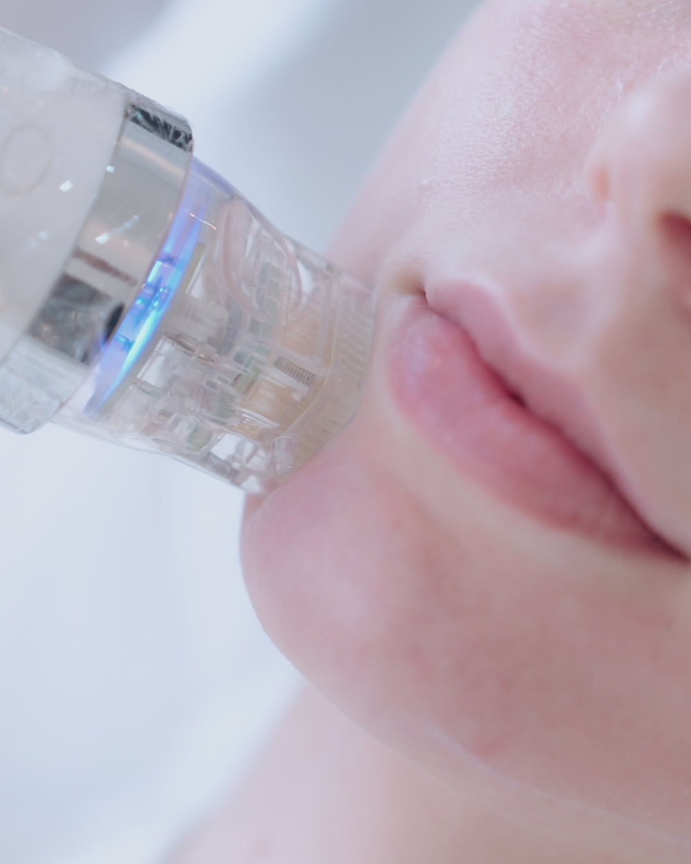 Fractional RF Microneedling